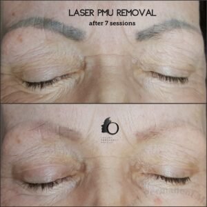 Laser Permanent Makeup Eyebrows Removal