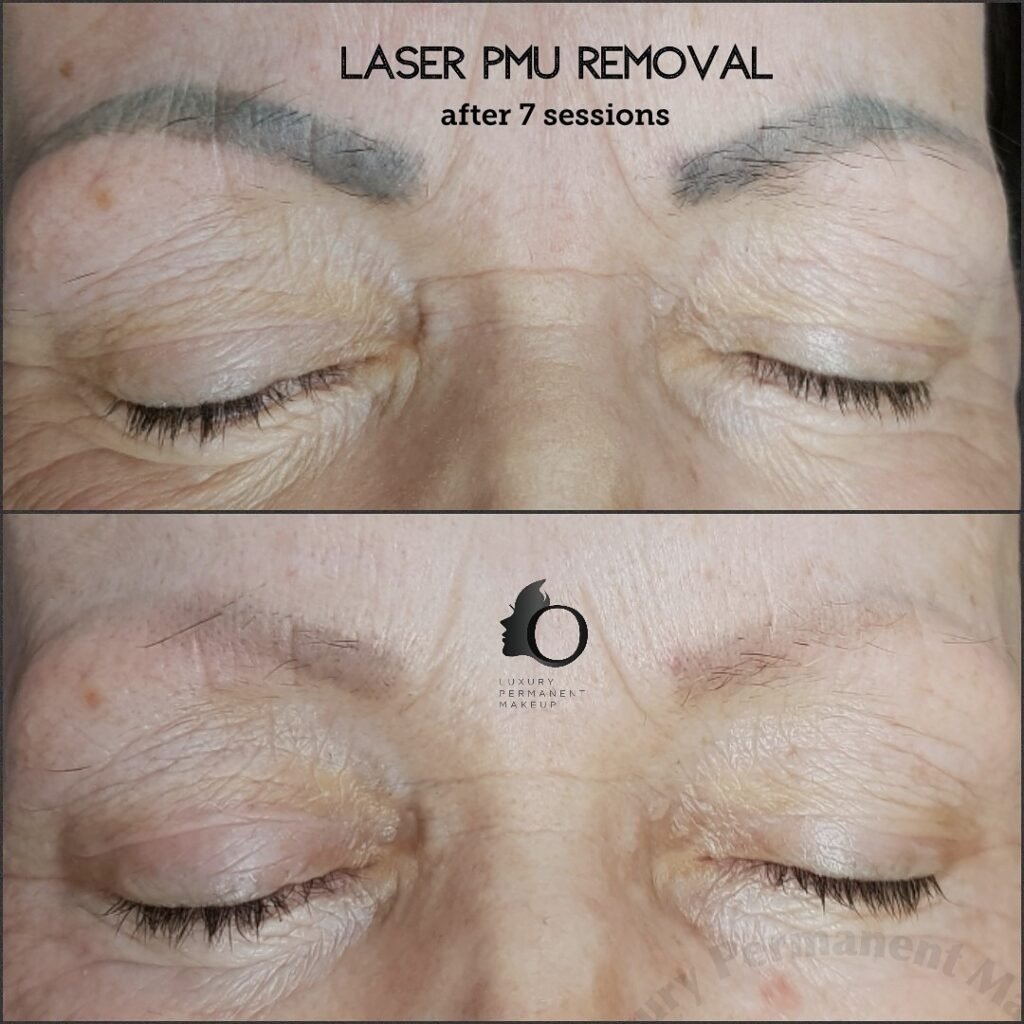 laser removal permanent makeup